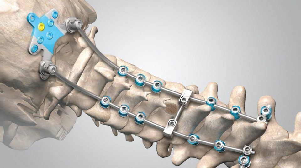 Posterior Cervical Fixation hardware system