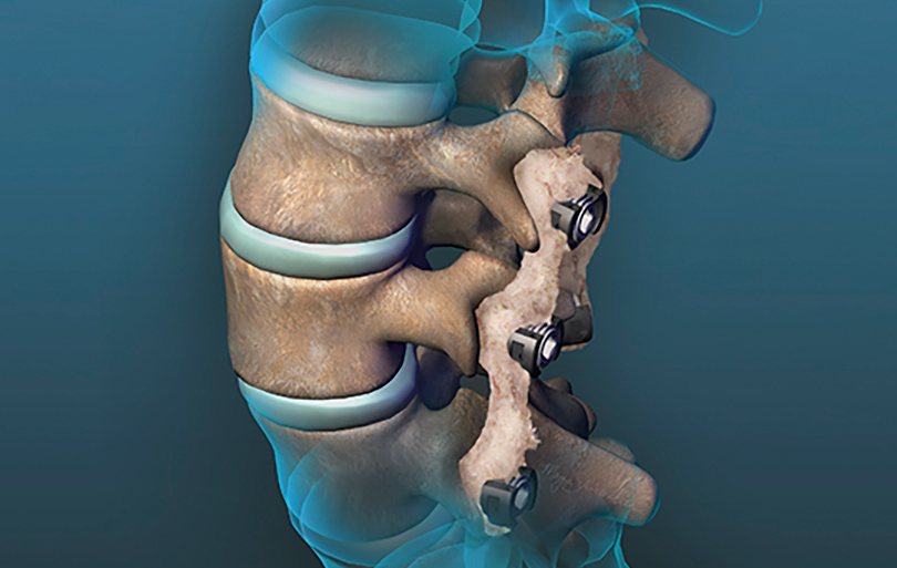 Orthofix IsoTis bone graft substitutes, DBM, and cellular allografts for orthopedic surgery