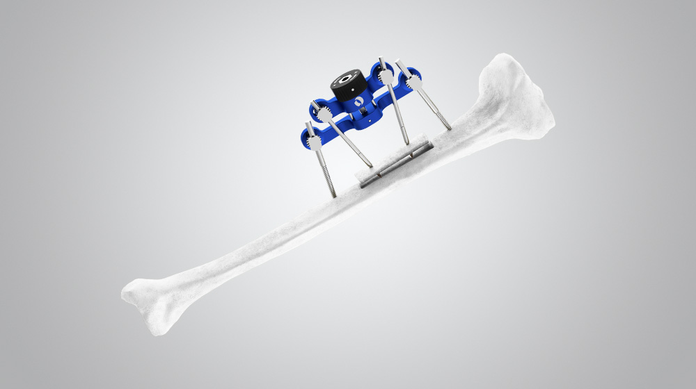 Orthofix TrueLok limb reconstruction hardware and deformity correction external fixators
