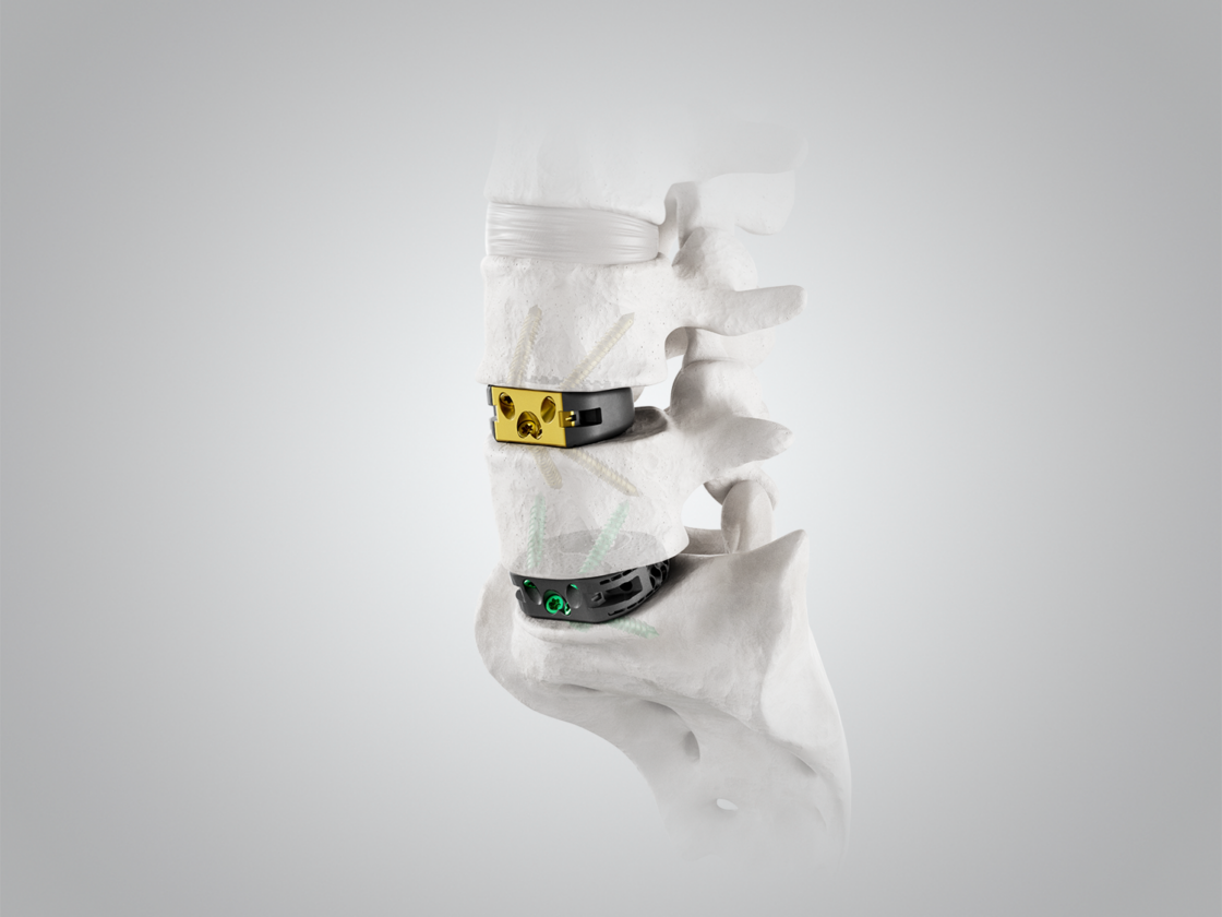 Lumbar Interbody Fusion Cage implant