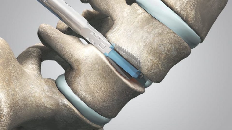 Posterior Thoracolumbar Fusion pedicle screw system
