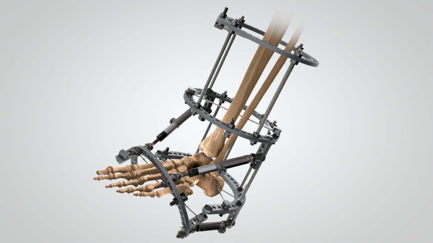Advanced Circular & Hexapod Ring Fixator System for complex limb reconstruction